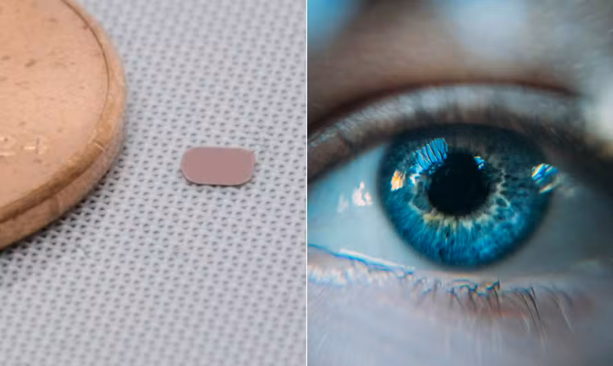 Implante de Chip Inovador Restaura Visão Central em Pacientes com Degeneração Macular